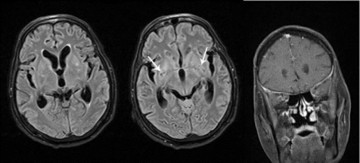 Two Young Adults Dead, 11 Hospitalized in Canterbury Meningitis Outbreak