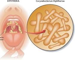 Diphtheria Surge in Australia Triggers National Response